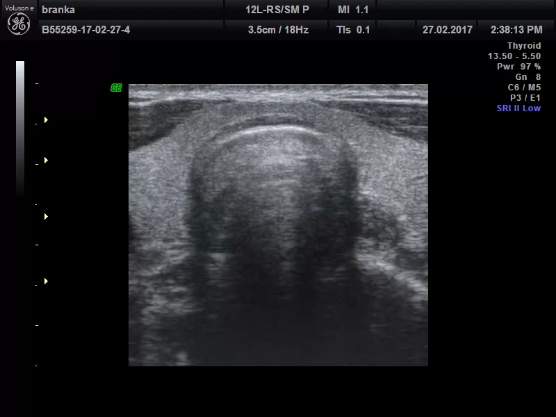 Ultrazvučni pregled štitne žlezde