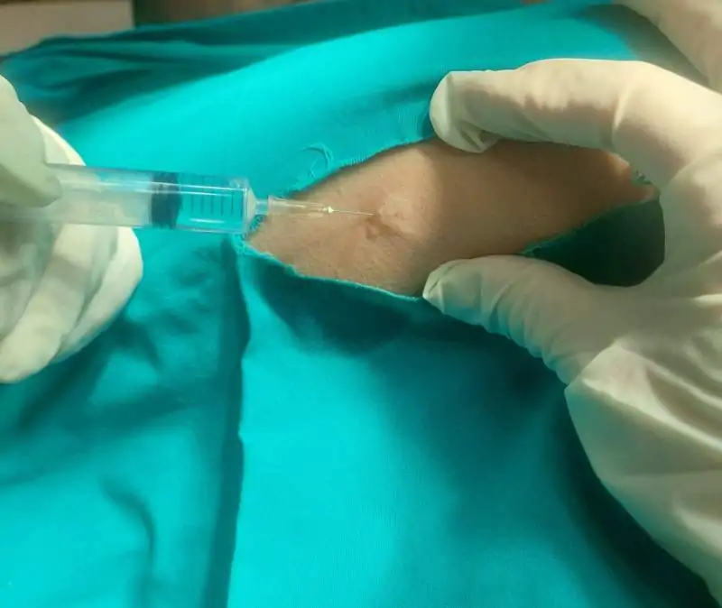 aterom uklanjanje aterom uklanjanje