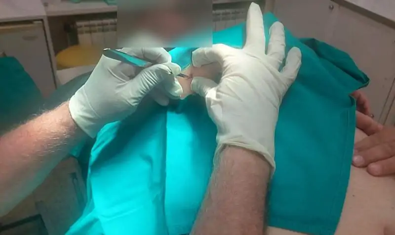 hirurško uklanjanje ateroma hirurško uklanjanje ateroma