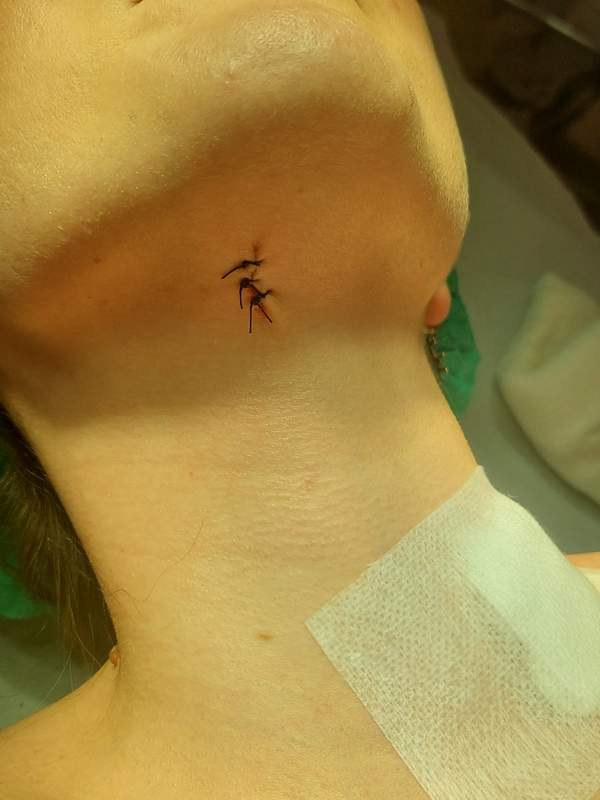 Uklanjanje Mladeža Hirurškim Putem Uklanjanje Mladeža Hirurškim Putem