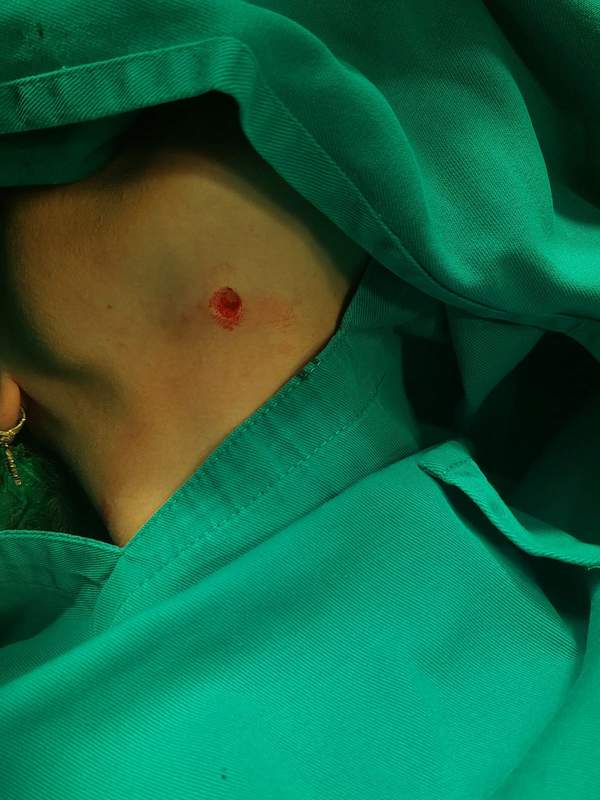 Uklanjanje Mladeža Hirurškim Putem Beograd Uklanjanje Mladeža Hirurškim Putem Beograd