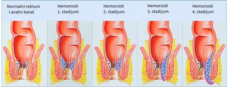 Operacija Hemoroida THD Metodom