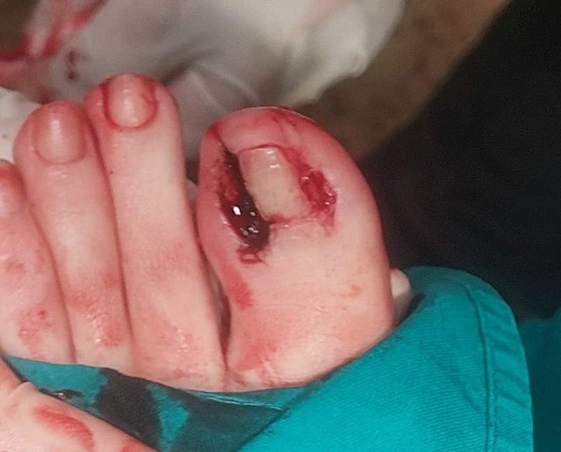 uklanjanje uraslog nokta uklanjanje uraslog nokta