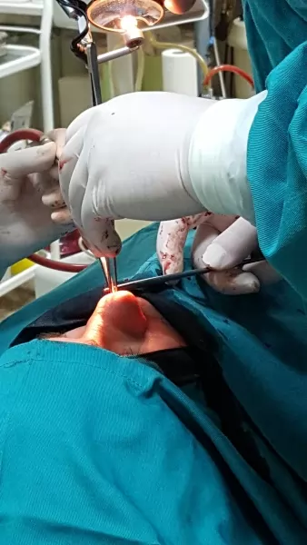 Hirurgija Nosa Operacija