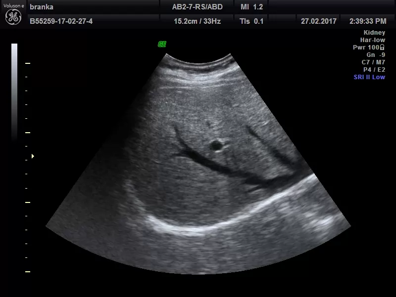 Ultrazvučni pregled abdomena
