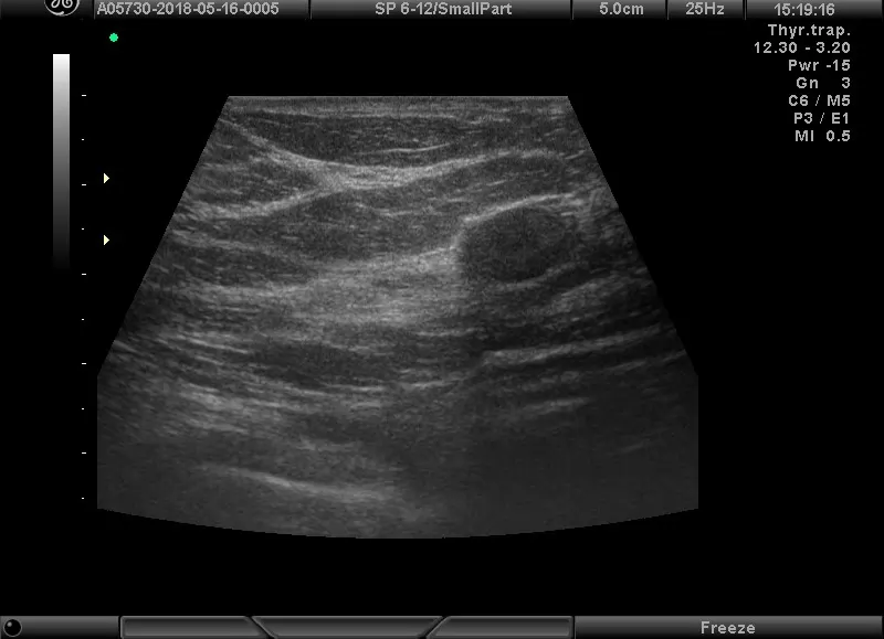 Ultrazvučni Pregled Dojke